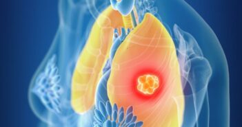 ASCO 2026: Selpercatinib shows decrease in risk of disease recurrence or death as adjuvant therapy for early-stage RET fusion-positive NSCLC