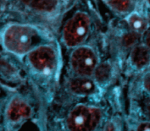 Amyloid plaques as blue dots in cells. Credit: Sylvester Comprehensive Cancer Center