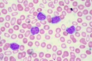 Chronic_Lymphocytic_Leukemia_900x600