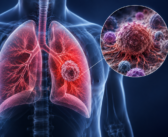 Chemoimmunotherapy linked to improved survival in PD-L1-high NSCLC meta-analysis