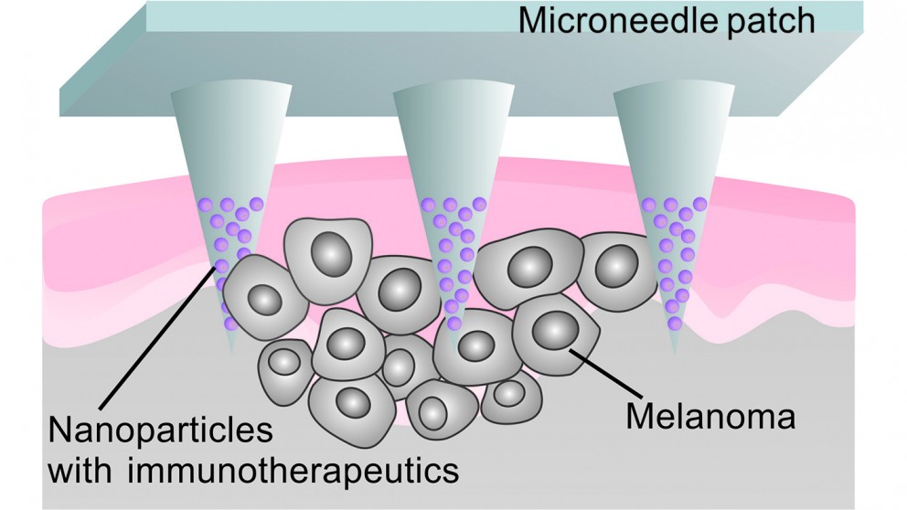 Microneedle patch