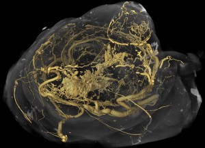 Oncology Network Australia Cancer imaging - bowel tumour blood vessels