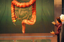 ONA Precancerous Colorectal Tumors