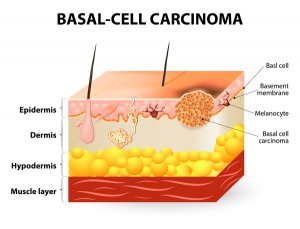 basal-cell-carcinoma_explainer_oncology news australia