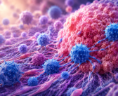 Immune profiling may refine chemotherapy decisions in ER-positive breast cancer