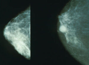 breast cancer imaging oncology new australia