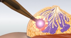 breast-cancer intrabream oncology news australia