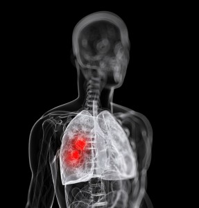 lung cancer oncologynewscomau_900x940