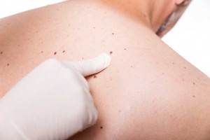 mole count melanoma_oncology news australia