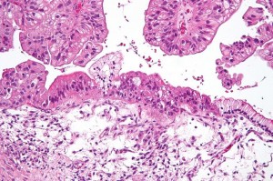 ovariancancer