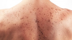 skin cancer_oncology news australia