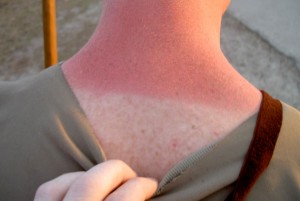 sunburn