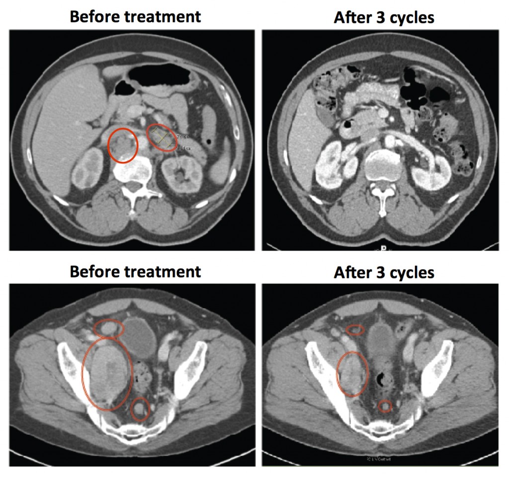 thwarting prostate cancer